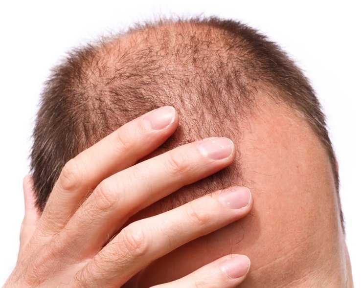 лысый мужчина