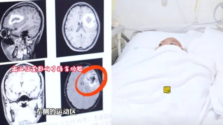 Китаянка забула мову, англійська мова, забула як говорити, крововилив у мозок, операція на мозку, рідкісний випадок, неврологія