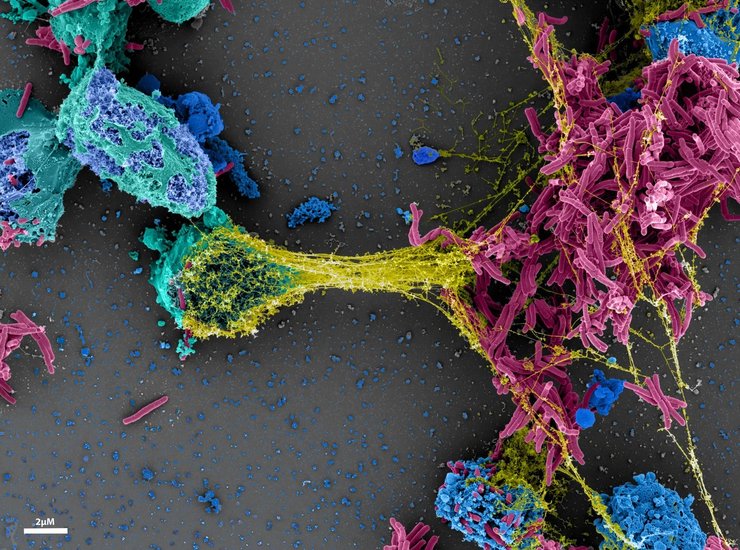 Имунные клетки, нейтрофилы, туберкулез