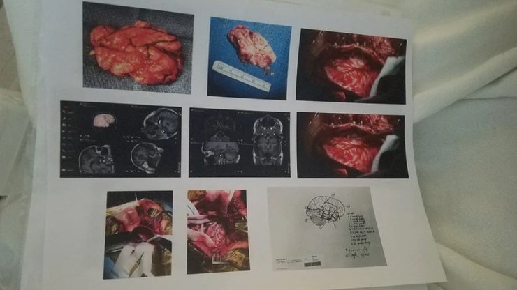 мозок, хірурги, операція,