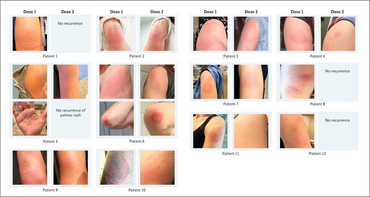 вакцина, реакція, Moderna