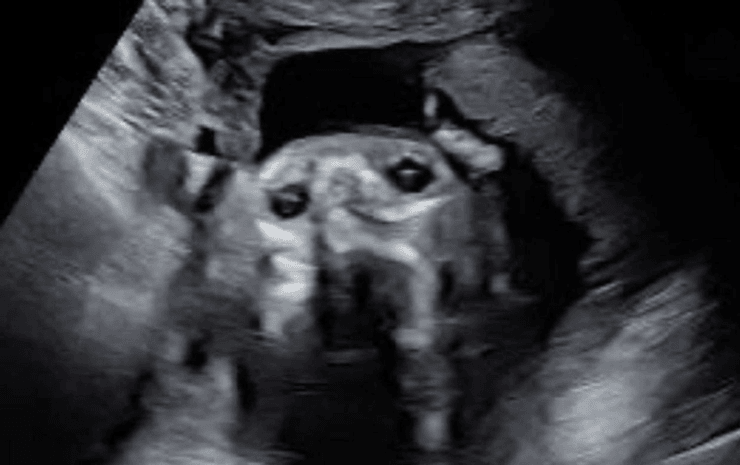 УЗД-знімок, на якому контури обличчя дитини нагадують мордочку собаки