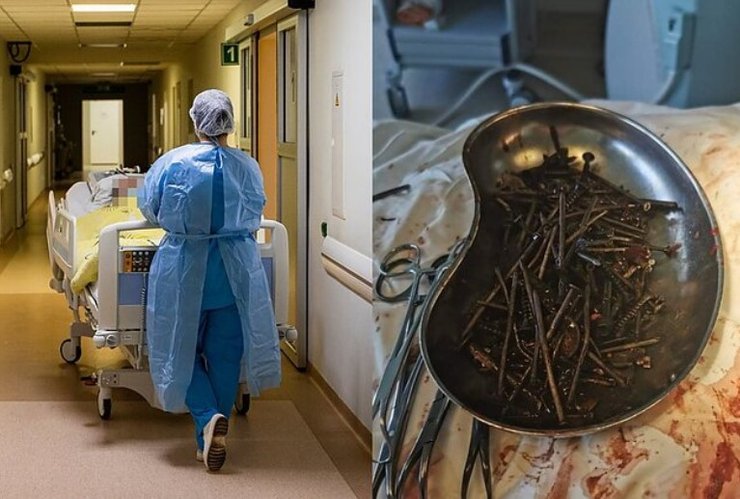 В желудке жителя Литвы обнаружили килограмм гвоздей и шурупов
