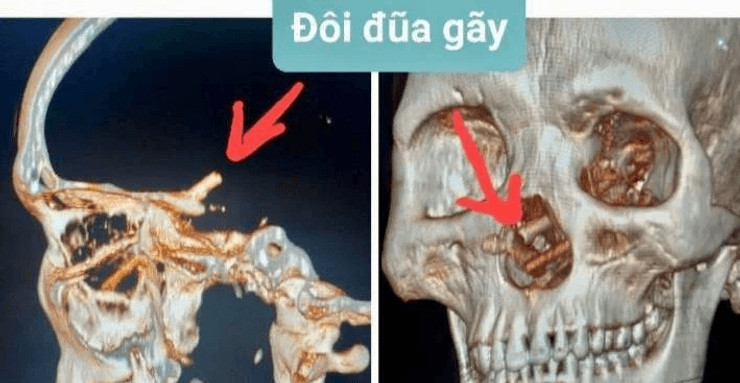 Палички для їжі, палички для їжі в черепі, втрачав зір, головний біль, не знав 5 місяців, зробили операцію, потрапили в ніс