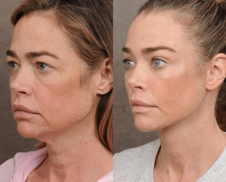 Деніз Річардс зробила підтяжку обличчя