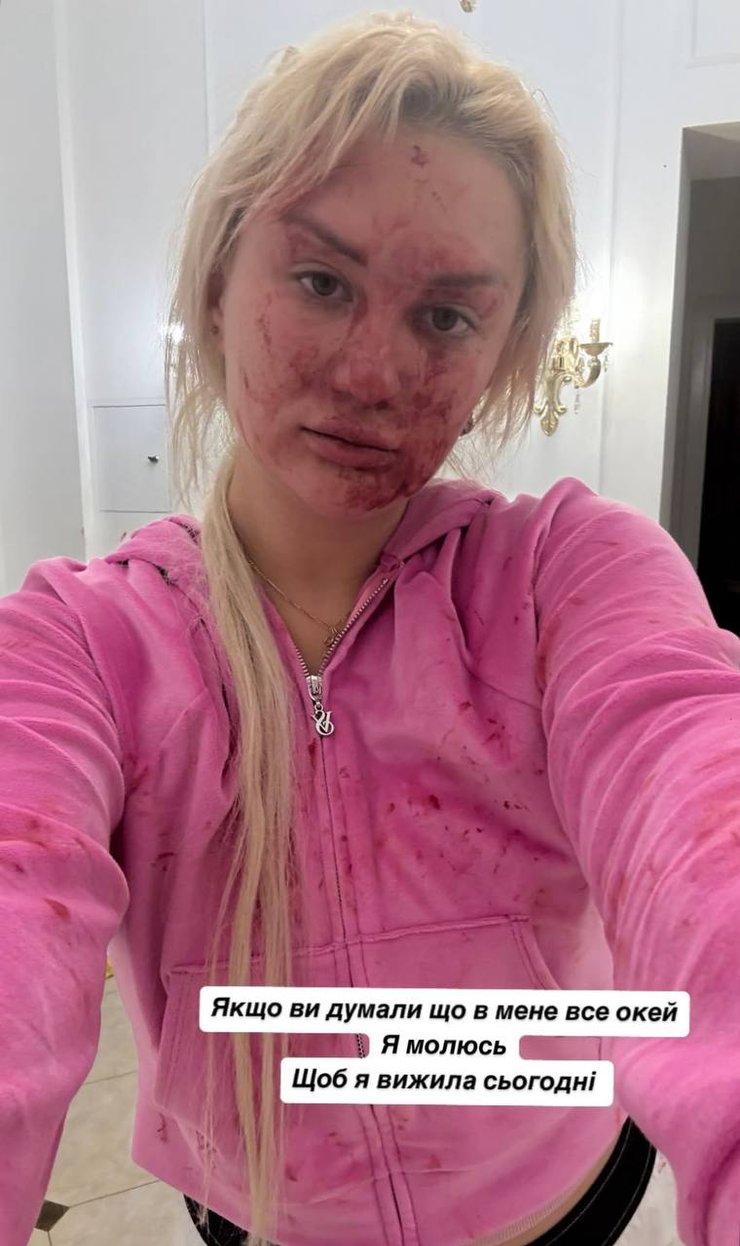 Фото "окровавленной" Алины Фибы