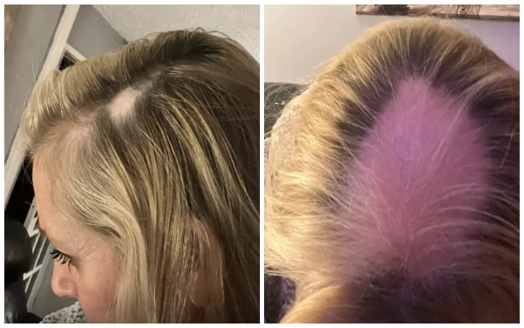 Облысение у женщин, причины и последствия, Линн Синклер лысеет