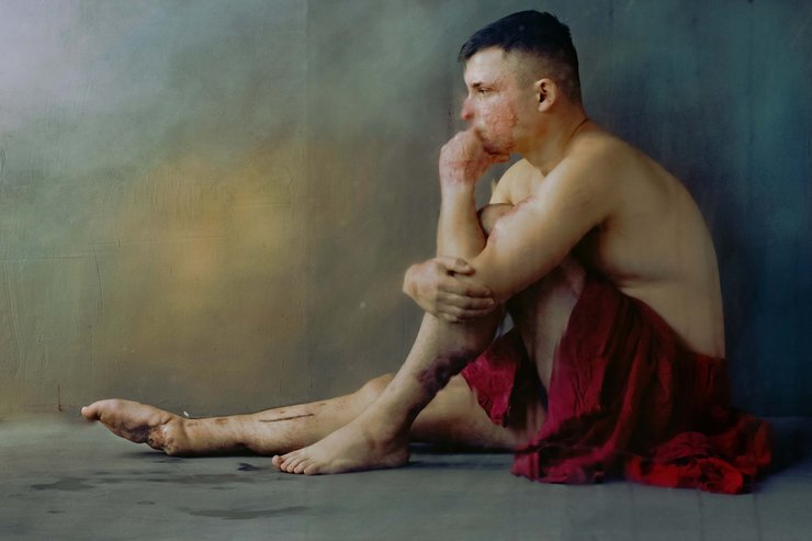 фотографиня Марта Сирко, Марта Сирко інваліди, Марта Сирко ампутація, ампутовані кінцівки, ампутант, поранені бійці