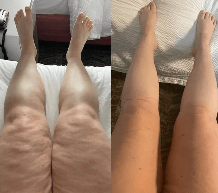 Ноги, ожиріння, повні ноги, хвороба, рідка хвороба, операція, ліпосакція,