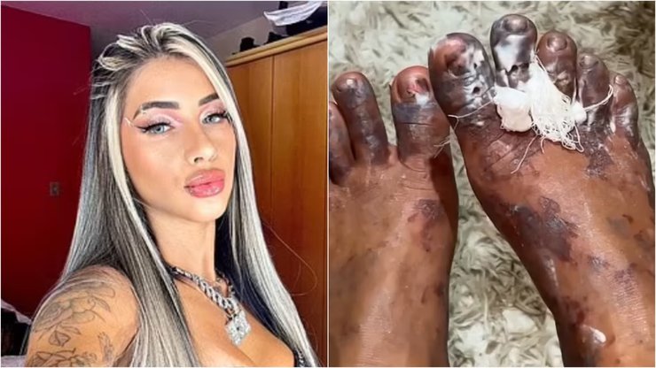 Ампутация пальцев на ноге, участие в челлендже, курьезы, реалити-шоу, Бразилия, фото, скандал, опасные развлечения