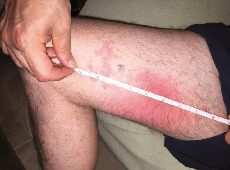 Слід від укусу оксамитового мурахи, найнебезпечніший мураха у світі, отруйні мурахи росії, найбільші мурахи, червоний вогняний мураха, вогняні мурахи укус, види мурах, найбільший мураха у світі, Чорний мураха