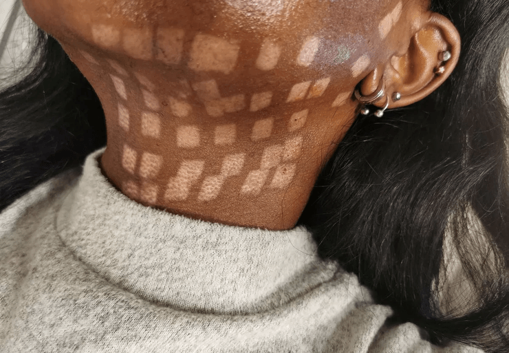 Женщине испортили кожу, лазерная эпиляция, шахматная доска, следы ожогов, ожоги на лице, редкая болезнь, стажер, рост волос