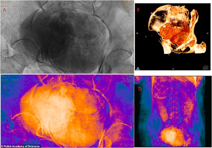 черевна порожнина, мумія, плід, знімок