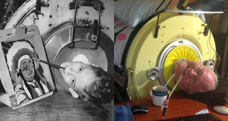 Чоловік із залізними легенями, апарат Залізні легені, Пол Александер, GoFundMe, історія життя, вірус, хвороба, залізні легені