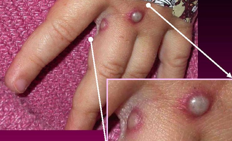 віспа мавп, мавпа віспа, спалах віспи мавп, вірус віспи мавп, спалах віспи в Європі, віспа в Європі, спалах вірусу, вірусна інфекція, віспа мавп симптоми, натуральна віспа, чорна віспа, рідке захворювання, випадок, віспа мавп вакцинація