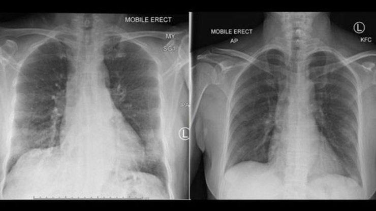 коронавирус, легкие