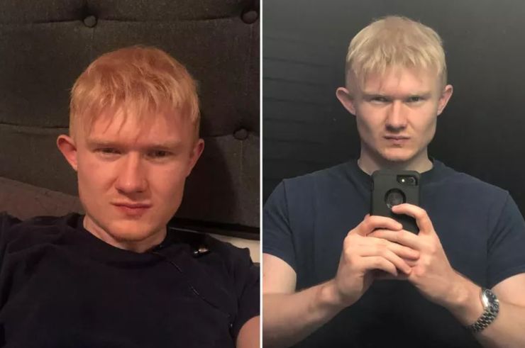 Облысение у мужчин до и после, потеря волос в молодом возрасте, какой выход из ситуации, опыт мужчины