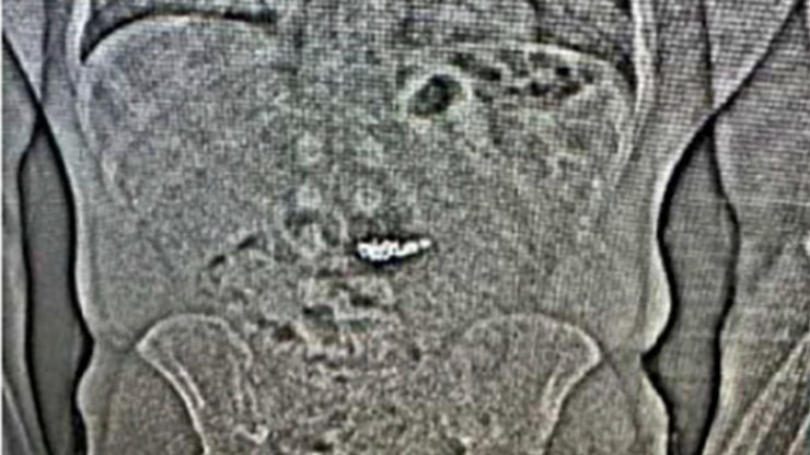 Сережки у тілі крадія