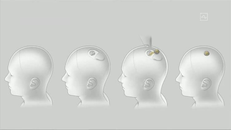 Neuralink, чип, нейрочип