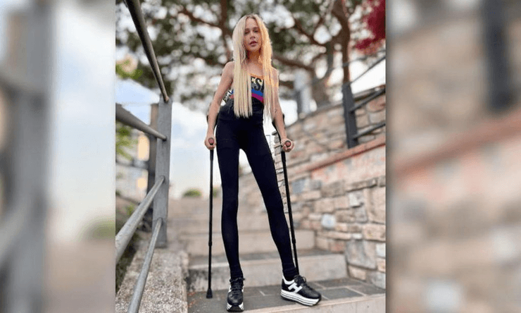 Модель, Терезия Фишер, операция, удлинение ног, снимок