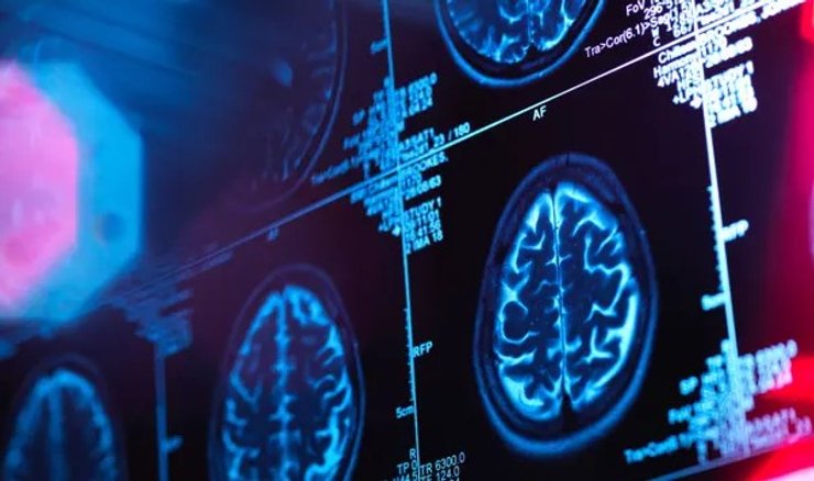 болезнь Альцгеймера