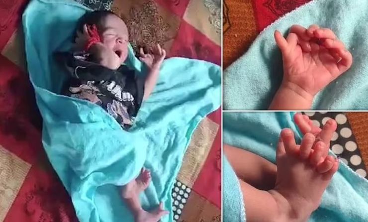 Новорожденный малыш, 7 пальцев на каждой руке и 6 на каждой ноге, признак величества, генетическая аномалия