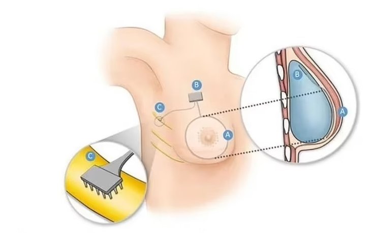 Біонічні груди
