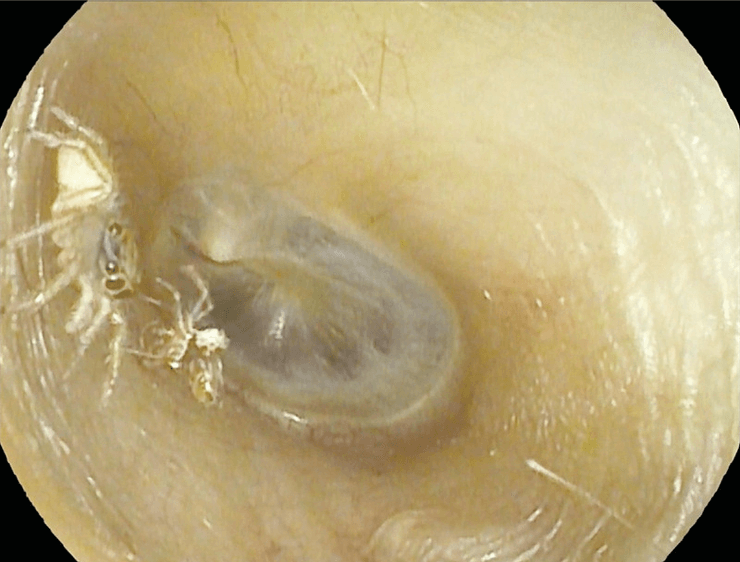 Паук в ухе женщины, ушной канал, паук в ухе, паук в ухе пенсионерки, достали паука из уха, шуршащие звуки, сбросил кожу