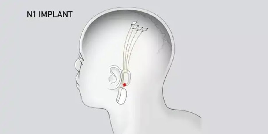 Фото: Neuralink; Screenshot by Stephen Shankland/CNET