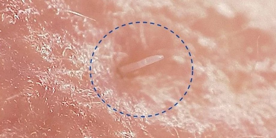 Demodex folliculorum