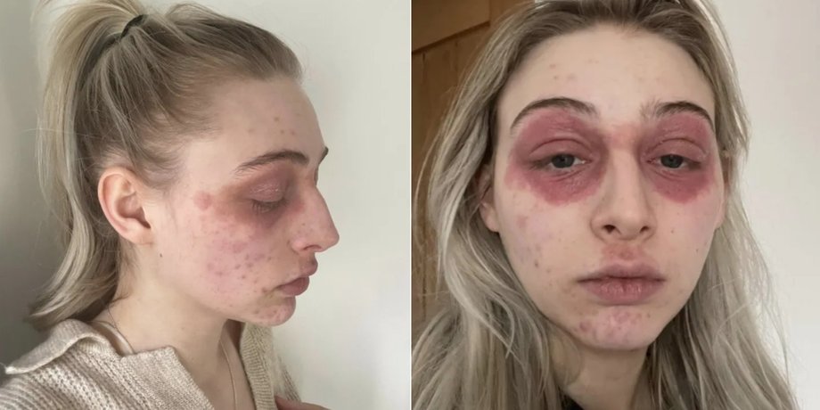 Харли Ватсон, аллергия, раздражение кожи на лице