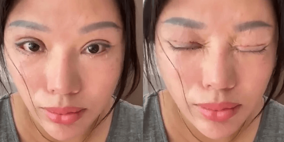 Неудачная блефаропластика