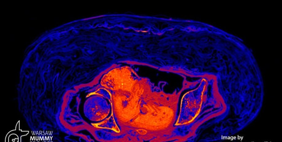 мумифицированный плод, беременный плод, сканирование, снимок