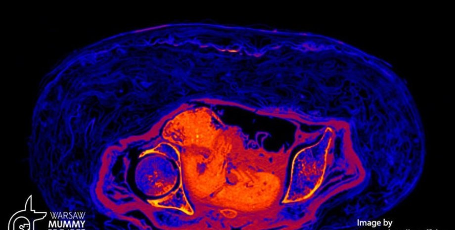 муміфікований плід, вагітний плід, сканування, знімок