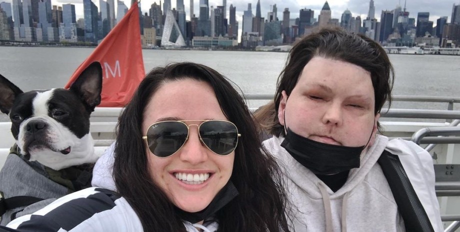 Джо ДиМео после пересадки лица встретил возлюбленную ДТП, авария, автокатастрофа, пересадка лица, трансплантация, операция, любовь, отношения, США, фото