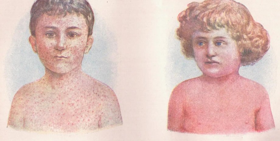корь, вирус, симптомы, ребенок, сыпь на теле, сыпь, болезнь