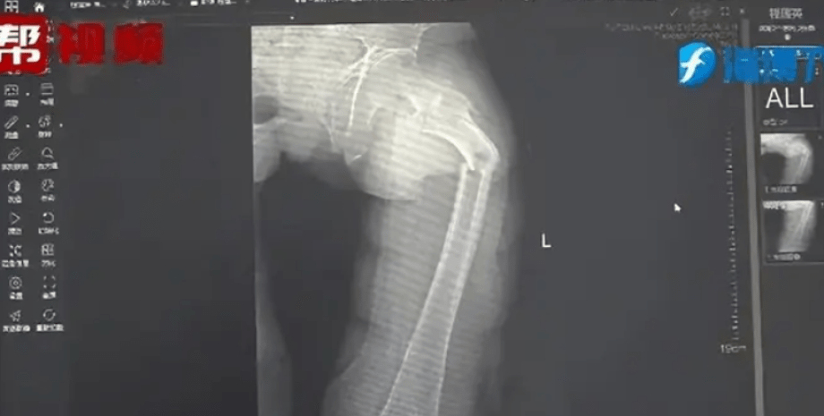 перелом стегнової кістки стегнова кістка, рентген, перелом