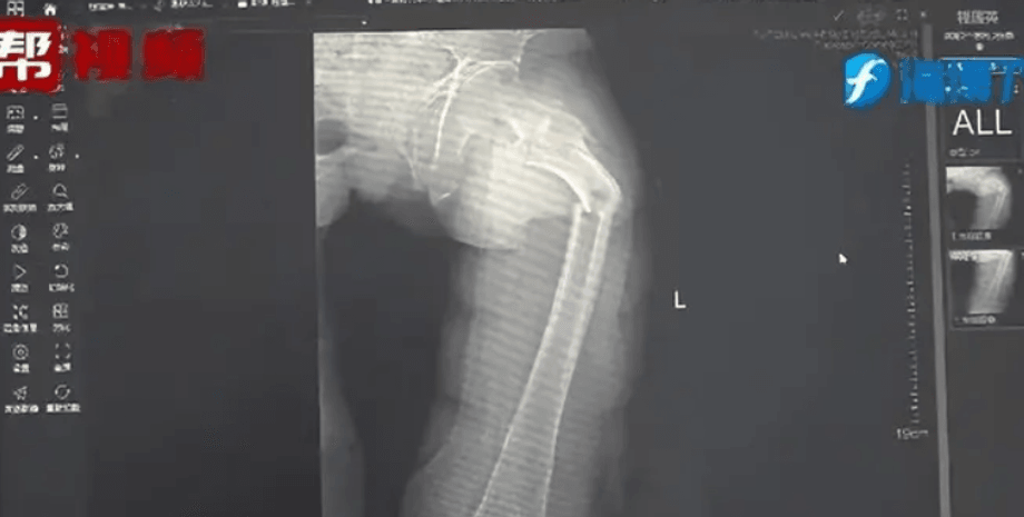 стегнова кістка, рентген, перелом
