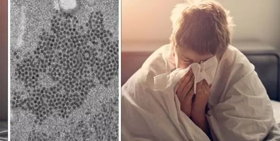 энтеровирус, энтеровирус D68, дети