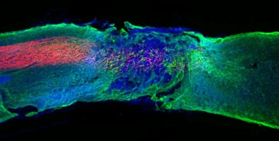 Повреждение, спинной мозг