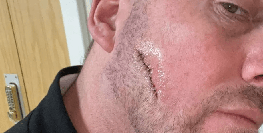 Шрам на лице Саймона