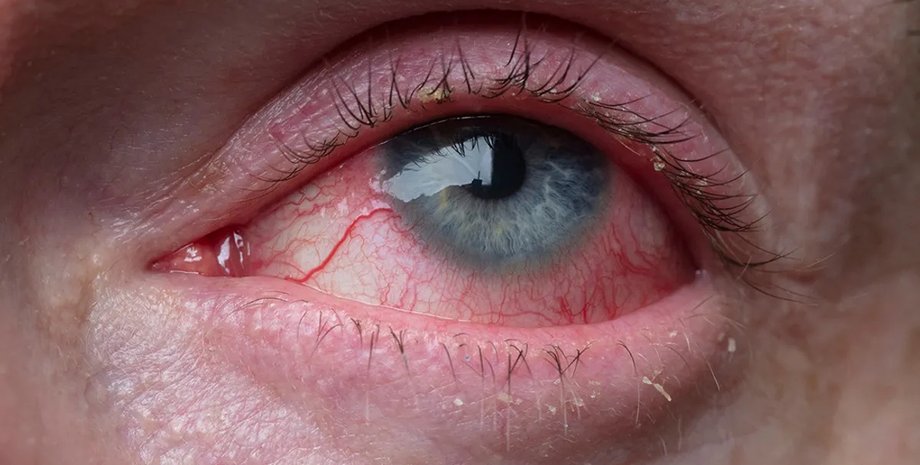 почервонілі очі очі безсоння