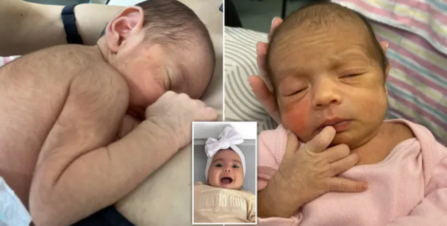 Волосся по всьому тілу в немовлят, зовнішність, дефекти, курйози, пологи, народження дітей, фото, Австралія