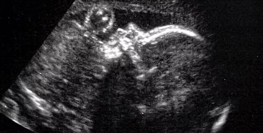 ребенок, плод, узи, узи плода