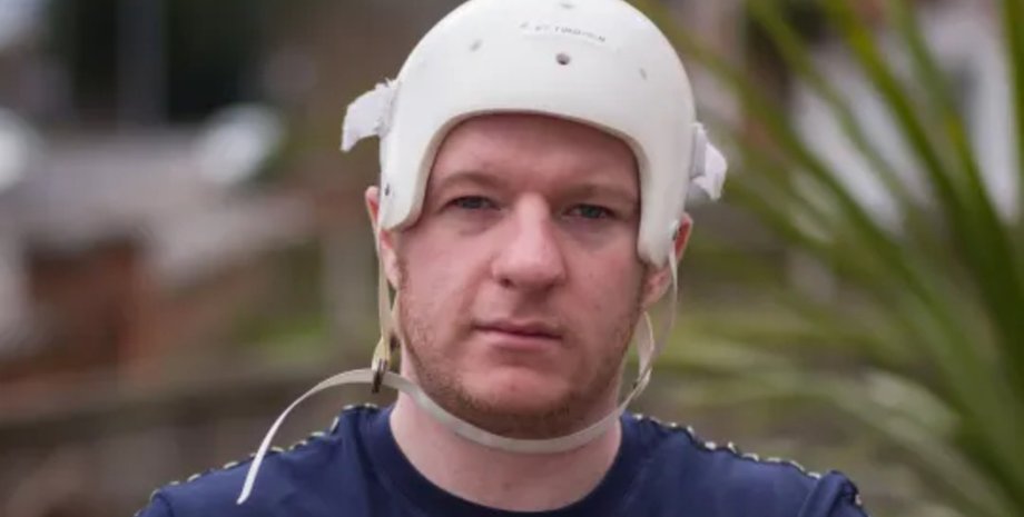 Операция по восстановлению черепа, удалили часть черепа, часть черепа из пластика, новаторская операция, получил удар