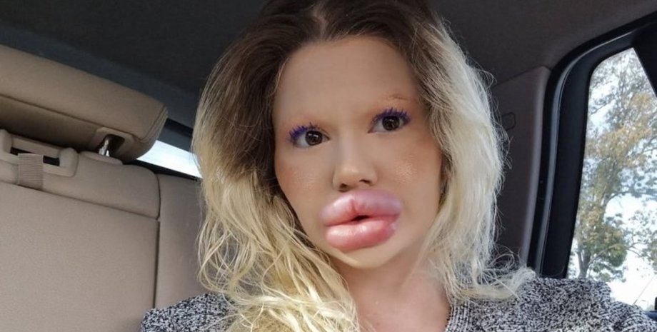 Жінка з найбільшими губами у світі страждає від болю та відмови від лікарів