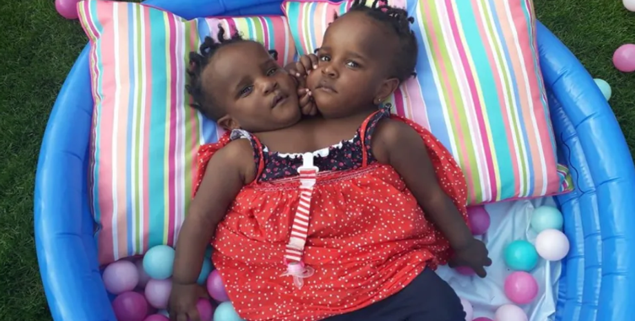 Сиамские близняшки, аномалии, болезни, диагнозы, фото, дети, Великобритания