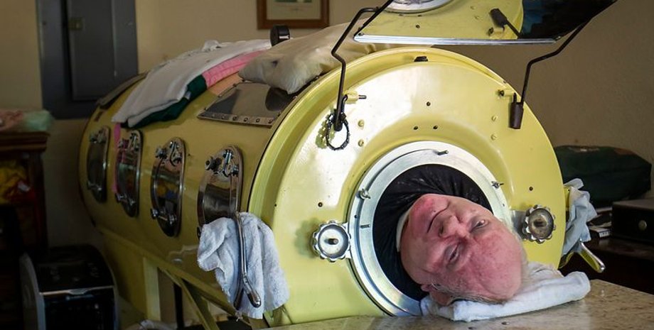 Чоловік із залізними легенями, апарат Залізні легені, Пол Александер, GoFundMe, історія життя, вірус, хвороба, залізні легені