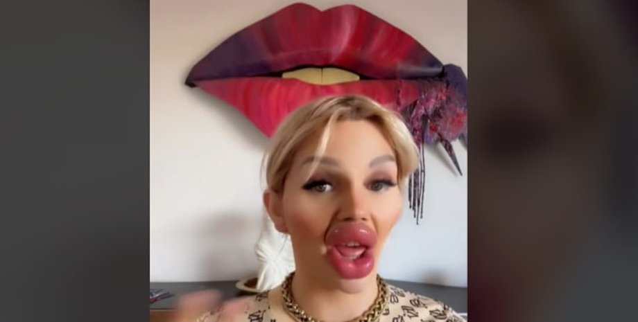 збільшення губ, пластика, філлери, наповнювач, вієнна вюрстель