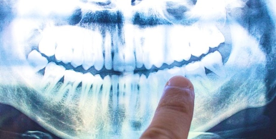 альцгеймер